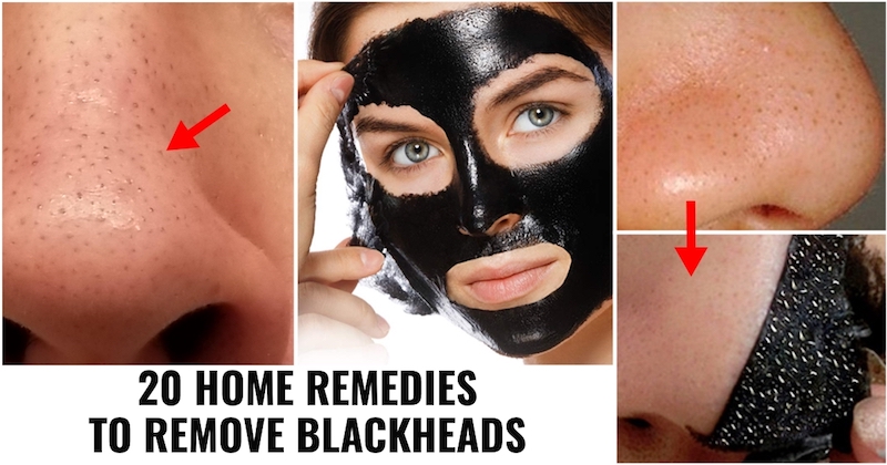 Home Remedies To Remove Blackheads