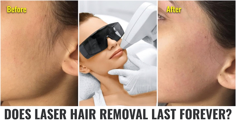 Laser hair removal technique