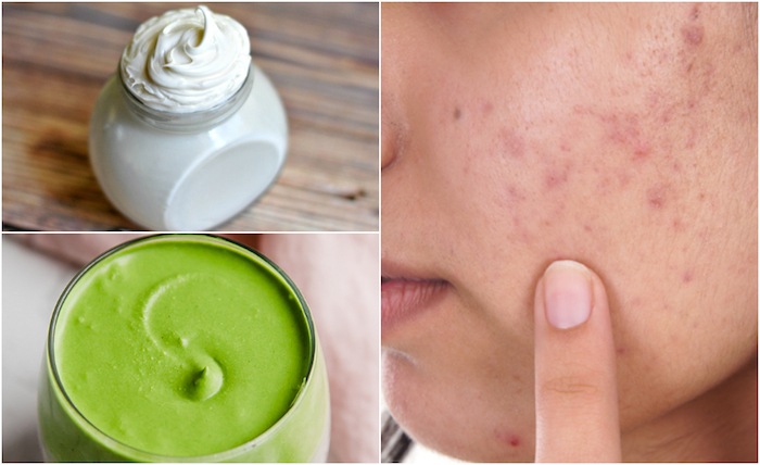 acne scars remedies copy