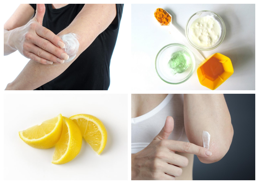How To Treat Dark Knees and Elbows Naturally