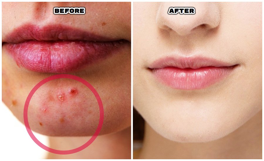 pimples before and after