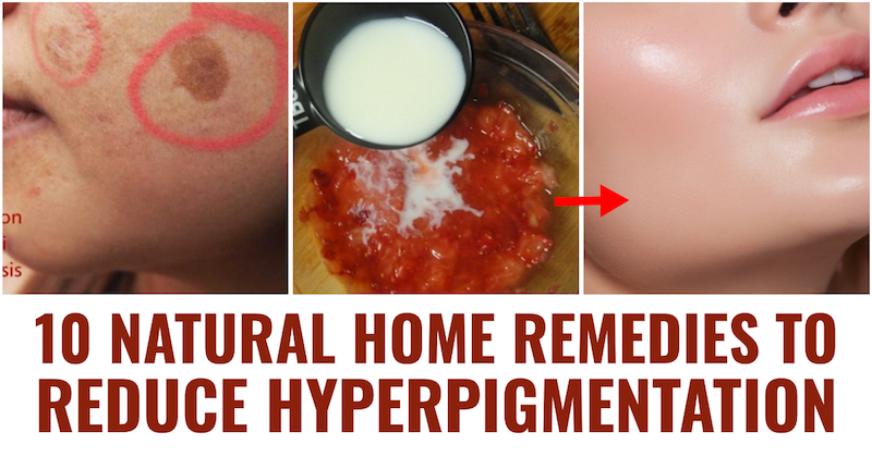 Natural Home Remedies to Reduce Hyperpigmentation