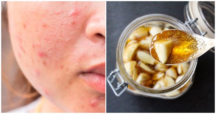 foods-that-can-trigger-acne