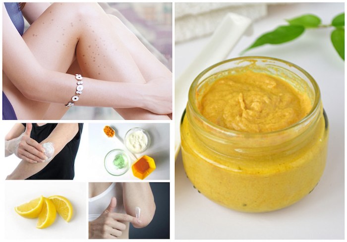 Get Rid Of Scars and black spots On Legs naturally - THE INDIAN