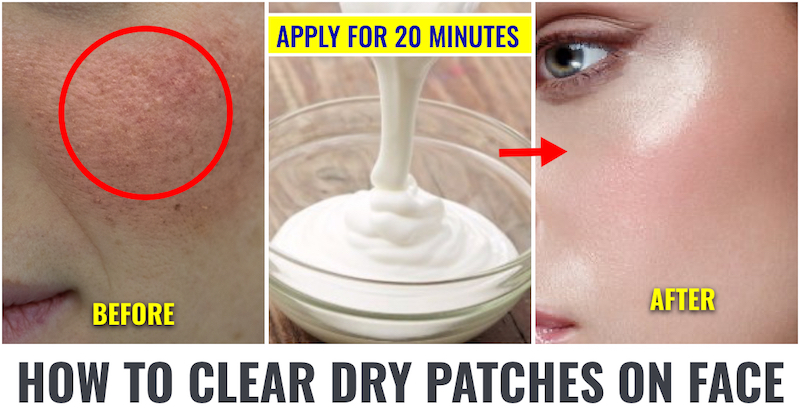 How to Clear dry patches on face