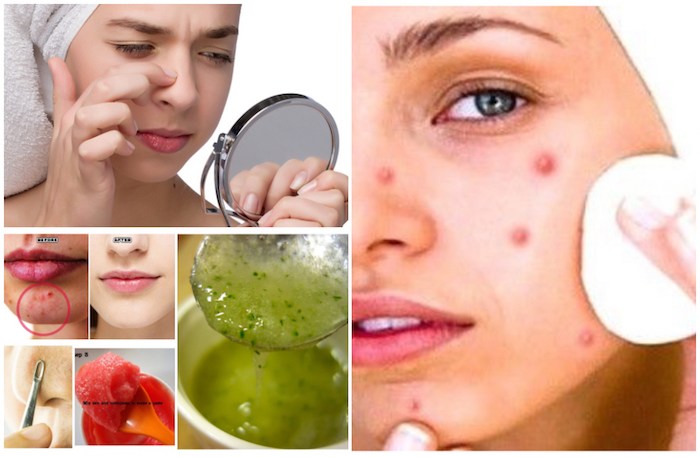 Home Remedies to Get Rid of Blind Pimples