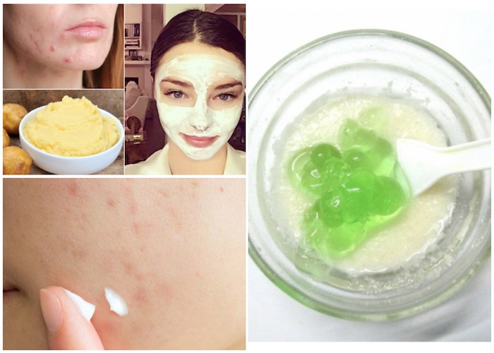 How to Get Rid of Acne Scars Fast at Home