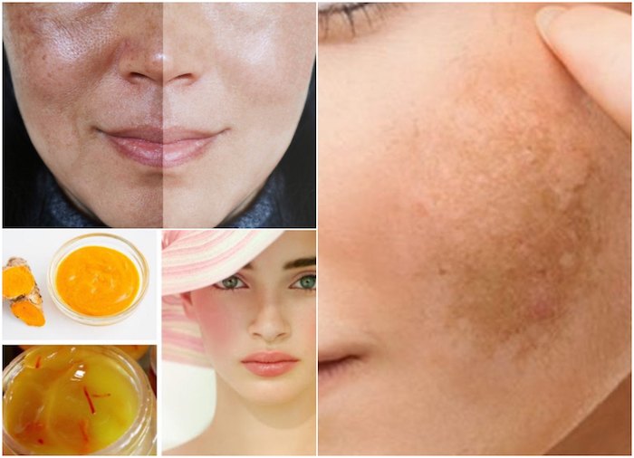 Homemade Remedies For Melasma and Dark Spots