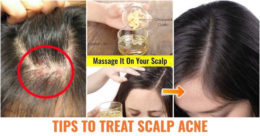 10 Ways To Get Rid of Scalp Acne Due To Dandruff 