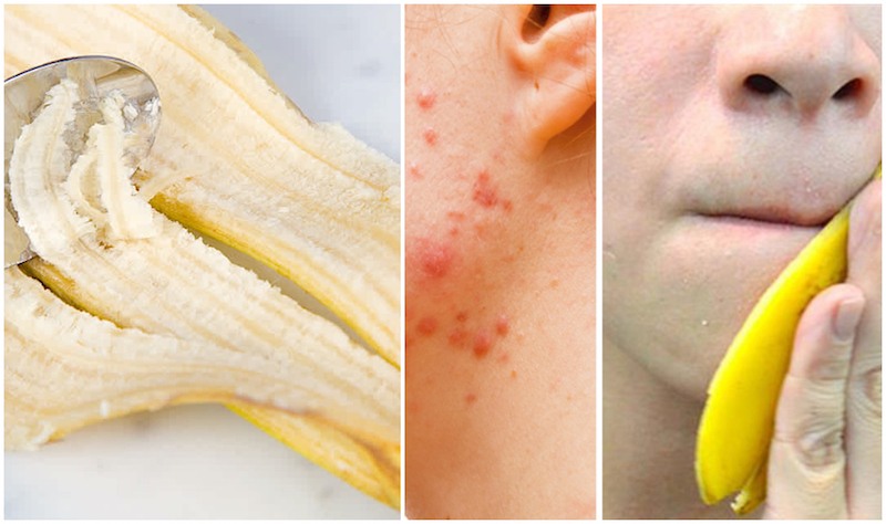 8 Amazing Ways To Use Banana Peel For Beautiful Skin 