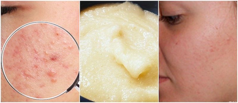 Home Remedies To Remove Dark Spots Caused by Pimples